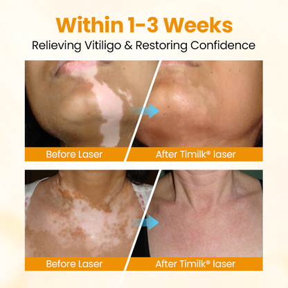 Timilk® VitiGone Rapid Spray — 2–3 Week Repigmentation with OTDS