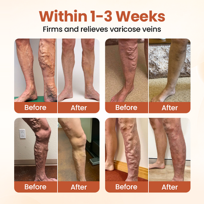 Timilk® VeinTarget Microneedle Patch.