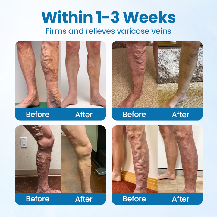 Timilk® VeinGuard Herbal Spray - Clinically Proven to Eliminate Varicose Veins in Just 7 Days!