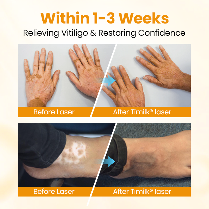 Timilk® VitiGone Rapid Spray — 2–3 Week Repigmentation with OTDS