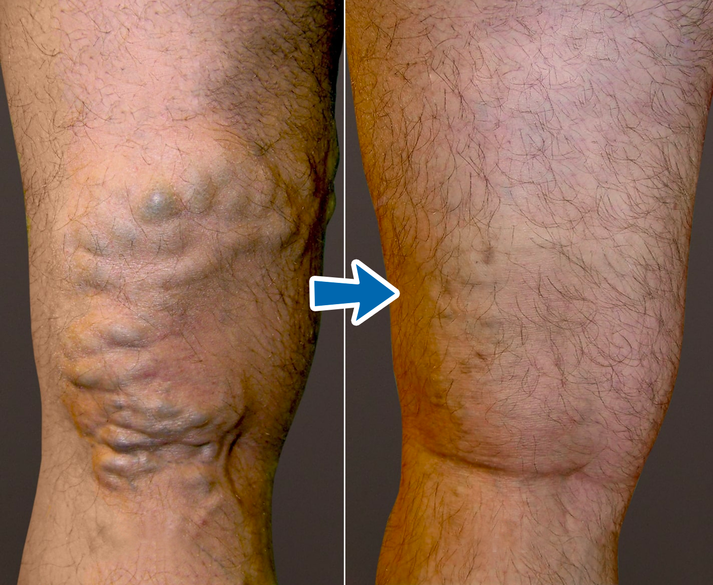 Timilk® VenoAid Varicose Solution Spray.