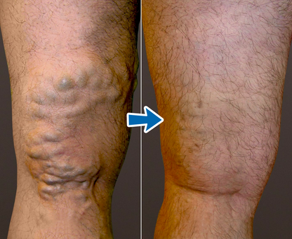 Timilk® VenoAid Varicose Solution Spray.
