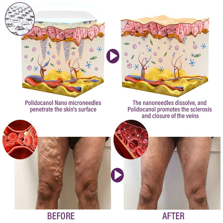 Timilk® Polidocanol Nano Varicose Vein Patch.