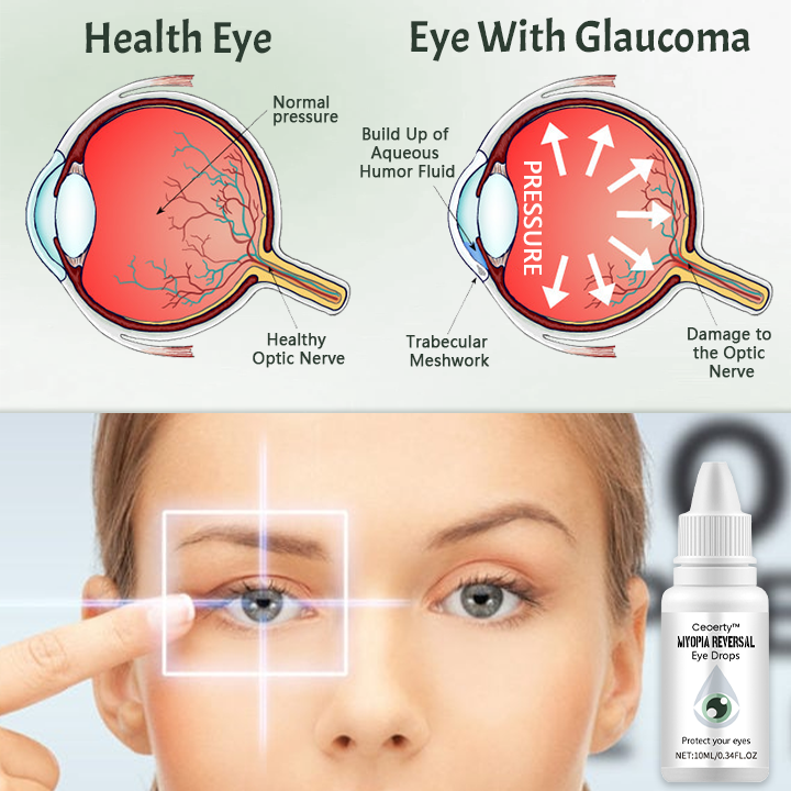 Ceoerty® Myopia Reversal Eye Drop.