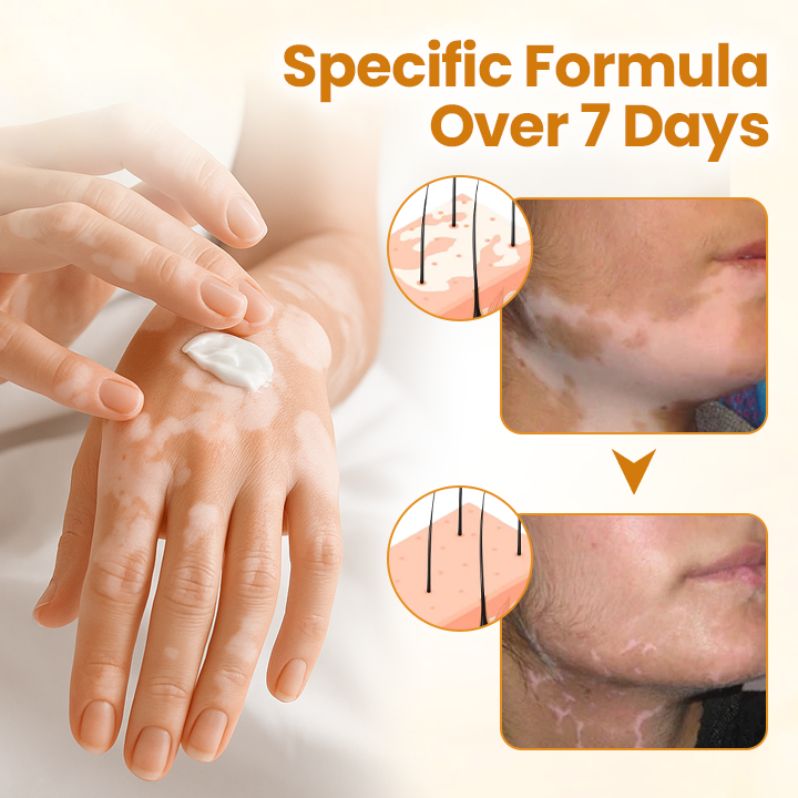 Timilk® VitiCalm Bee Venom Cream.