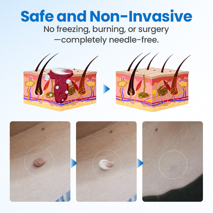 Timilk® TagGone Wart Removal Cream.