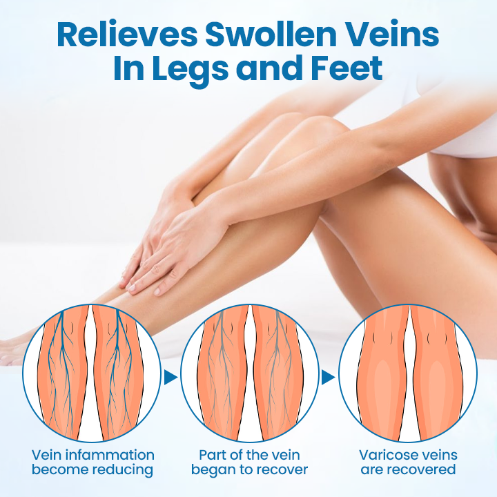 Timilk® VeinGuard Herbal Spray - Clinically Proven to Eliminate Varicose Veins in Just 7 Days!