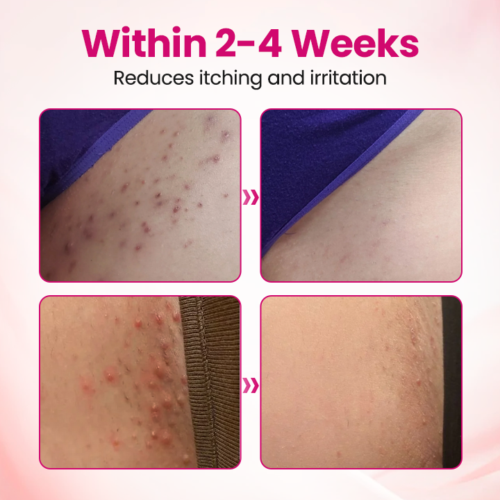 Timilk® IntiDefend Anti-HPV Interferon Gel.